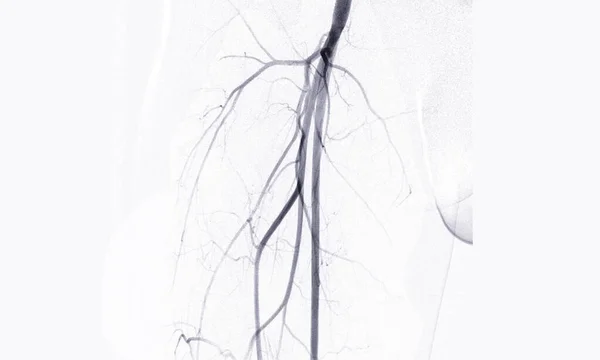 Angiografía Angiografía Arteria Femoral — Foto de Stock