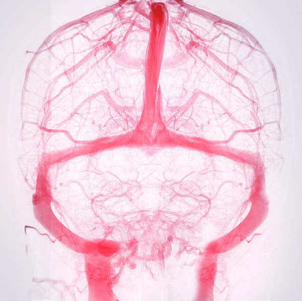 Cerebral Angiography Image Fluoroscopy Intervention Radiology Showing Cerebral Artery — стоковое фото