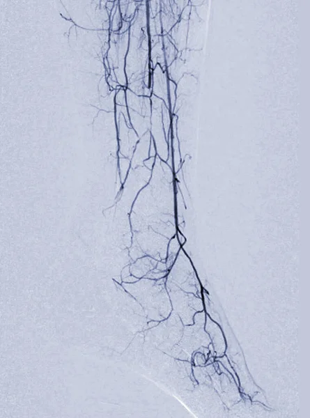 Angiorgam Angiograma Plantar Mostrando Artéria Plantar Tarsal Área — Fotografia de Stock