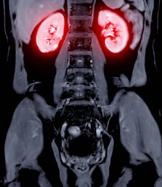 stock image Magnetic resonance urography (MR urography) is a MRI study that predominantly used to image congenital abnormalities of the urinary system. 