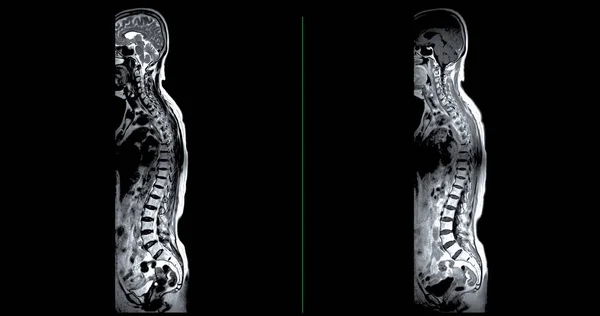 Resonancia Magnética Columna Entera Para Diagnóstico Compresión Médula Espinal —  Fotos de Stock
