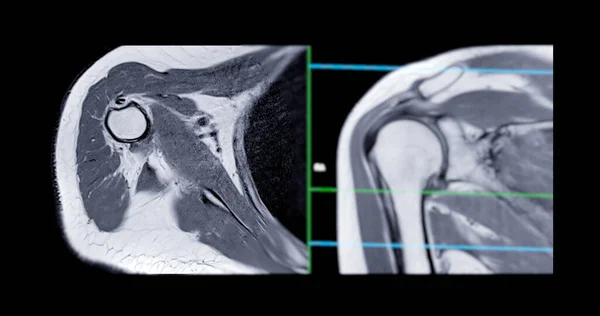 Magnetic Resonance Imaging or MRI of Shoulder Joint  for diagnostic shoulder pain.