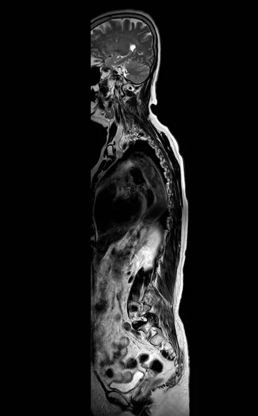 Resonancia Magnética Columna Entera Para Diagnóstico Compresión Médula Espinal — Foto de Stock