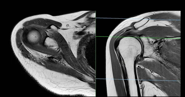 Магнітно Резонансна Томографія Або Мрт Плечового Суглоба Діагностики Болю Плечі — стокове фото