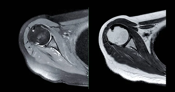 Rezonans Magnetyczny Lub Rezonans Magnetyczny Stawu Barkowego Diagnostycznego Bólu Barku — Zdjęcie stockowe