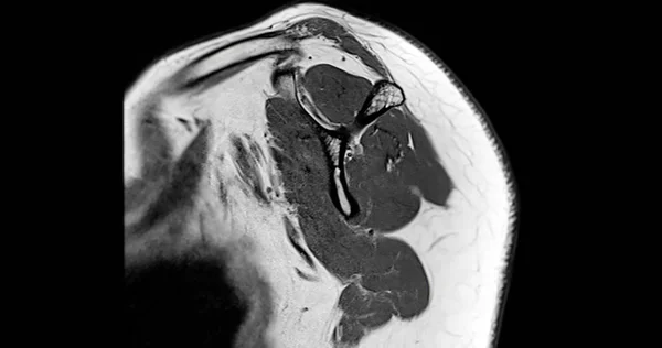 Магнітно Резонансна Томографія Або Мрт Плечового Суглоба Діагностики Болю Плечі — стокове фото