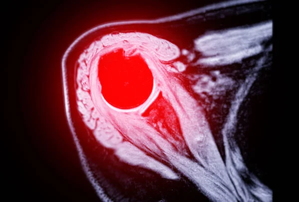 Imagerie Par Résonance Magnétique Irm Articulation Épaule Pour Diagnostiquer Douleur — Photo