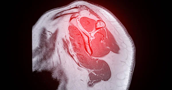 Magnetic Resonance Imaging or MRI of Shoulder Joint  for diagnostic shoulder pain.
