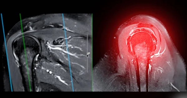Imagem Ressonância Magnética Articulação Ombro Para Diagnóstico Dor Ombro — Fotografia de Stock