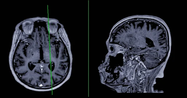 Mri脳スキャン 脳疾患 脳腫瘍および感染症として脳疾患の寿命を検出するための基準線を持つ軸線および賢明な視点 — ストック写真