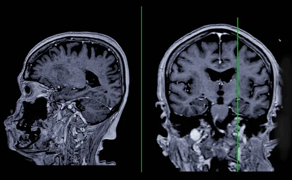 Мрт Мозок Сканування Сагітальний Корональний Погляд Еталонною Лінією Виявлення Захворювань — стокове фото