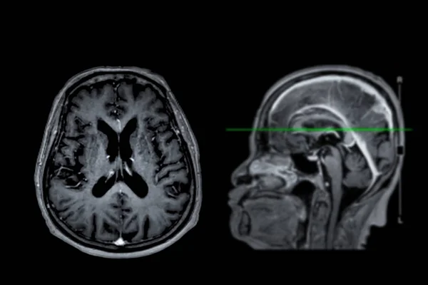 Мрт Мозга Сканировать Осевой Сагиттальный Вид Опорной Линией Обнаружения Заболеваний — стоковое фото
