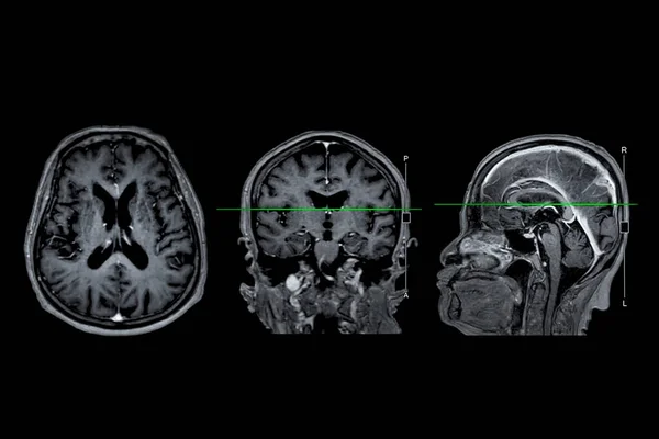 Mri Brain Scan Axial Coronal Sagittal View Referance Line Detect — Stock Photo, Image