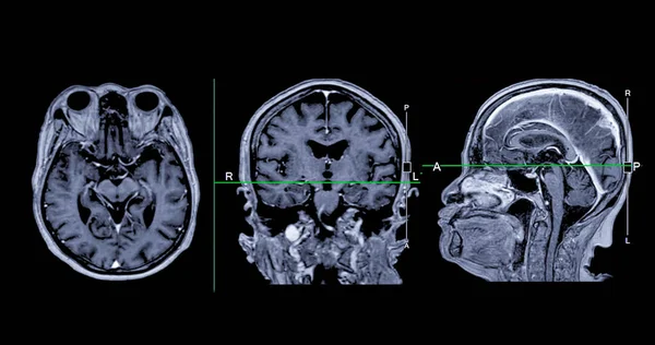 Mri脳スキャン 脳疾患 脳腫瘍および感染症として脳疾患の寿命を検出するための参照ラインが付いている軸線 角および賢明な眺め — ストック写真