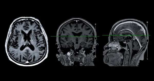 Mri脳スキャン 脳疾患 脳腫瘍および感染症として脳疾患の寿命を検出するための参照ラインが付いている軸線 角および賢明な眺め — ストック写真