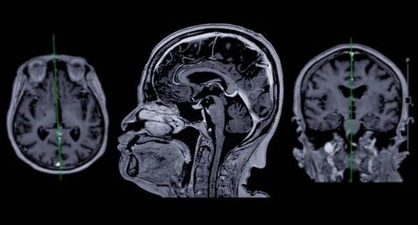 MRI  brain scan Axial , Coronal and sagittal view with referance line for detect  Brain  diseases sush as stroke disease, Brain tumors and Infections.
