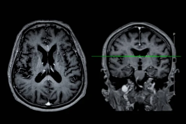 Мрт Сканування Мозку Осьовий Корональний Погляд Еталонною Лінією Виявлення Захворювань — стокове фото