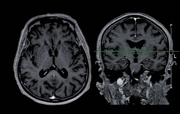 MRI  brain scan Axial and coronal view with reference line for detect  Brain  diseases sush as stroke disease, Brain tumors and Infections.