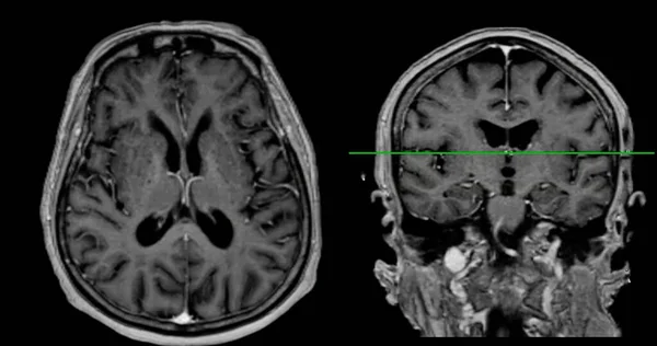 MRI  brain scan Axial and coronal view with reference line for detect  Brain  diseases sush as stroke disease, Brain tumors and Infections.