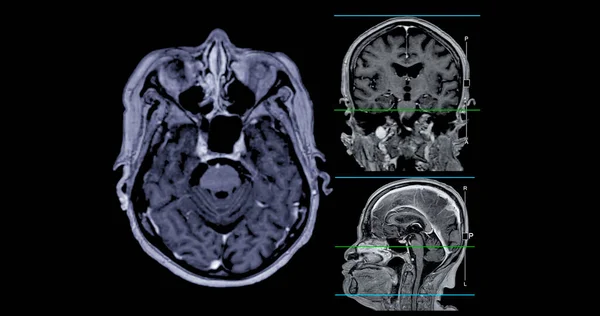 Irm Scanner Cérébral Vue Axiale Coronale Sagittale Avec Ligne Référence — Photo