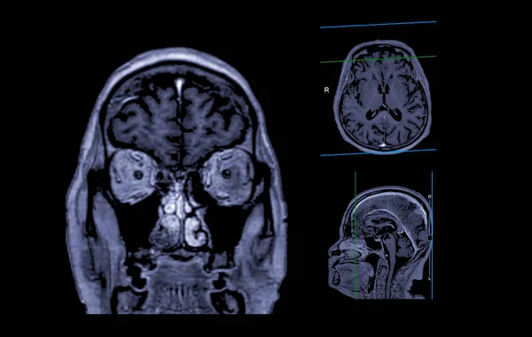 MRI  brain scan Axial , Coronal and sagittal view with referance line for detect  Brain  diseases sush as stroke disease, Brain tumors and Infections.