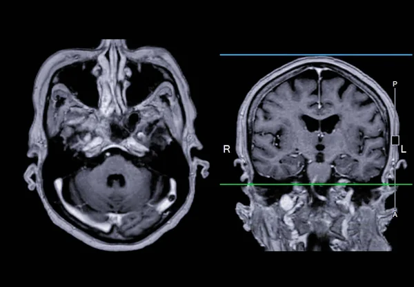 Ressonância Magnética Cérebro Visão Axial Coronal Com Linha Referência Para — Fotografia de Stock