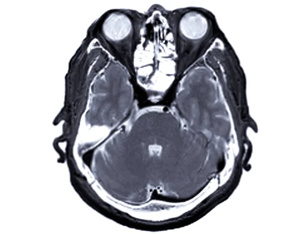 Мрт Мозга Сканировать Осевой Вид Обнаружения Суши Болезни Мозга Инсульта — стоковое фото