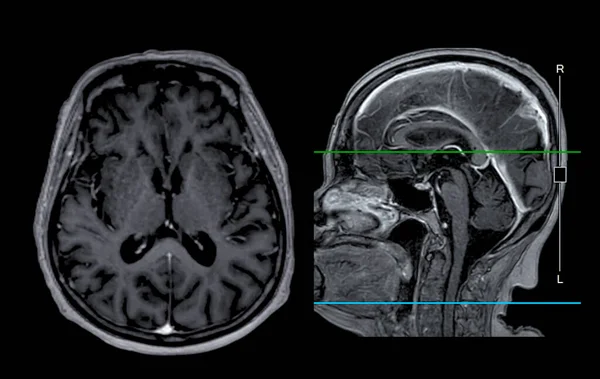 MRI  brain scan Axial  and sagittal view with reference line for detect  Brain  diseases sush as stroke disease, Brain tumors and Infections.