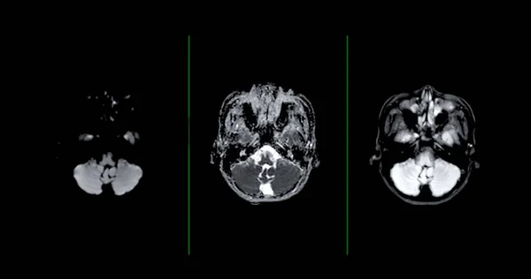 Мрт Мозга Сканирования Осевой Метод Диффузии Обнаружения Суши Болезни Мозга — стоковое фото
