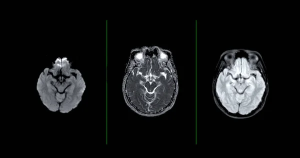 Mri脳は脳疾患 脳腫瘍および感染症として脳疾患の寿命を検出するための軸拡散技術をスキャンします — ストック写真