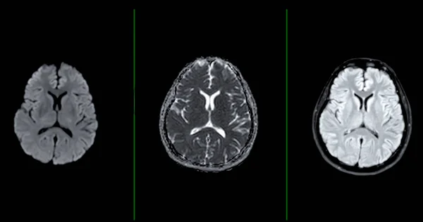 Мрт Мозок Сканує Осьовий Метод Дифузії Виявлення Захворювань Головного Мозку — стокове фото