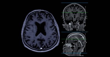 Beyin taraması, eksen, koronal ve sagital görüş. Beyin hastalıklarını tespit etmek için referans hattı. Felç, beyin tümörleri ve enfeksiyonlar gibi..