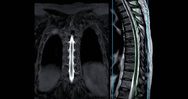 MRI T-L omurga veya Thoracosacral koronal ve sagittal T2 tekniği teşhis için referans hattı spinal sıkıştırma.