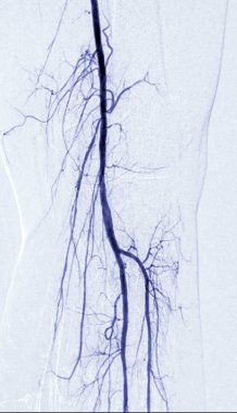 Diz bölgesinde uyluk atardamarı anjiyografisi ya da anjiyografi..