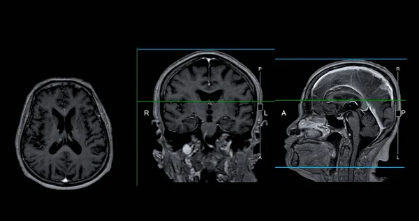 Mri脑扫描的轴线 冠状和矢状视点 可作为脑卒中 脑瘤和感染等脑病的鉴别依据 — 图库照片