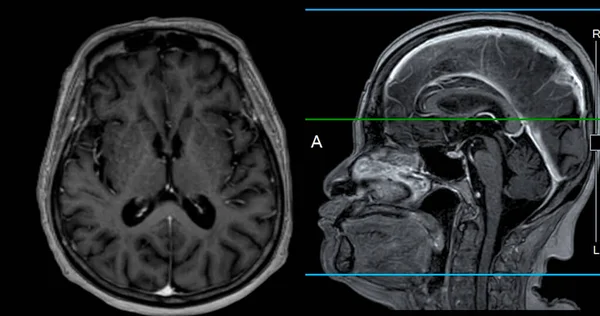 Мрт Мозга Сканировать Осевой Сагиттальный Вид Опорной Линией Обнаружения Заболеваний — стоковое фото