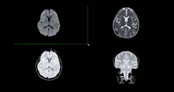 Mri Cérebro Varredura Axial Técnica Difusão Grediente Coronal Para Detectar — Fotografia de Stock