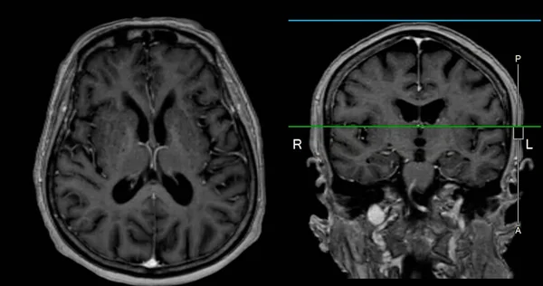 Мрт Сканування Мозку Виявлення Захворювань Головного Мозку Інсультних Захворювань Пухлин — стокове фото