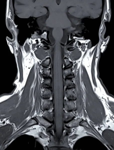 MRI of  C-spine or magnetic resonance image of cervical spine Coronal  view  for diagnosis spondylosis and compression fracture.