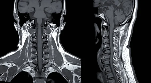 子宮頸椎コロナのC Spineまたは磁気共鳴のイメージのMriおよび診断の脊柱症および圧縮の骨折のための賢明な眺め — ストック写真