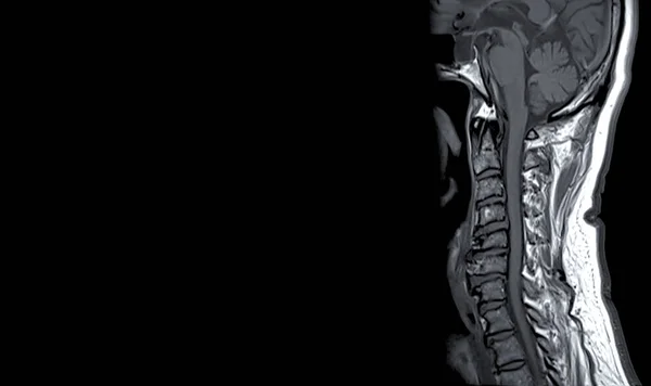 診断のための子宮頸椎の背骨の視野のC Spineまたは磁気共鳴のイメージのMriおよび圧縮の骨折 — ストック写真