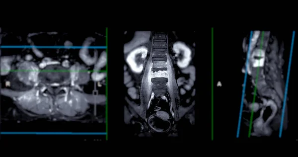 Irm Colonne Vertébrale Lombaire Sagittal Technique Pour Diagnostic Compression Moelle — Photo