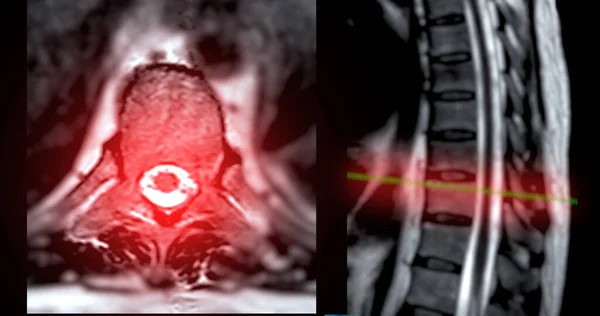 Mri LスパインまたはソラコサクラルスパインAxialおよびSegittal T2テクニック 診断脊髄圧縮のための参照ライン — ストック写真