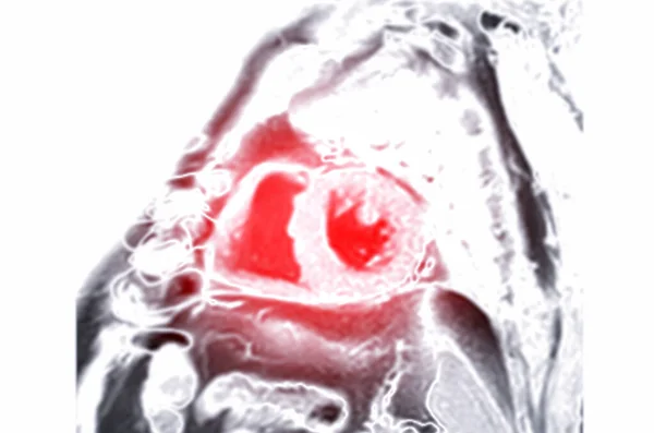 心臓疾患の診断のための心臓短軸ビューのMri心臓Mri 磁気共鳴画像法 — ストック写真