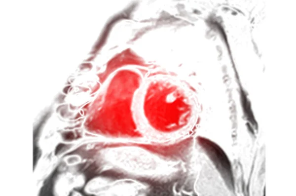 Resonancia Magnética Resonancia Magnética Vista Del Eje Corto Del Corazón — Foto de Stock