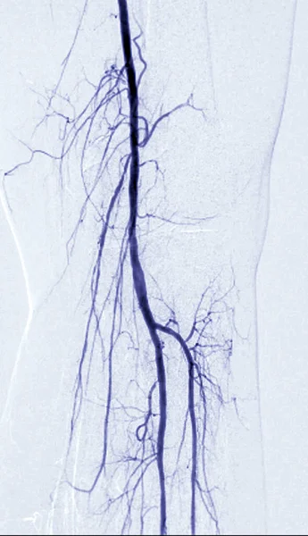 Angiografía Arteria Femoral Angiografía Área Rodilla —  Fotos de Stock