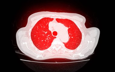 Pulmoner embolizm (PE), akciğer kanseri ve covid-19 için göğüs ekseni görüntüsü CT taraması. 