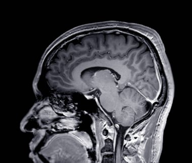 MRI beyin taraması sagittal T1W düzlemi tespit etmek için Beyin hastalıklarını felç, beyin tümörleri ve enfeksiyonları gibi sush.