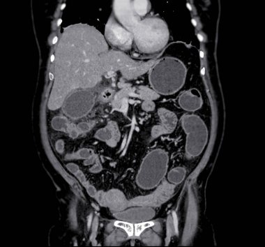  Kontrastlı medya koronal görünümlü tüm karın tomografisi.