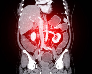 Kontrastlı medya koronal görünümlü tüm karın tomografisi.
